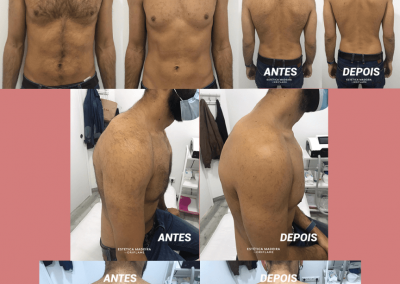 Depilação Laser - Estética Madeira