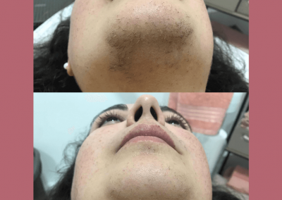 Depilação Laser - Estética Madeira