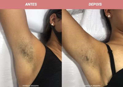 Depilação Laser - Estética Madeira