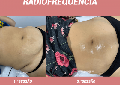 Radiofrequência - Lipoaspiração não invasiva