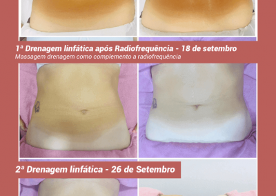 Radiofrequência - Lipoaspiração não invasiva